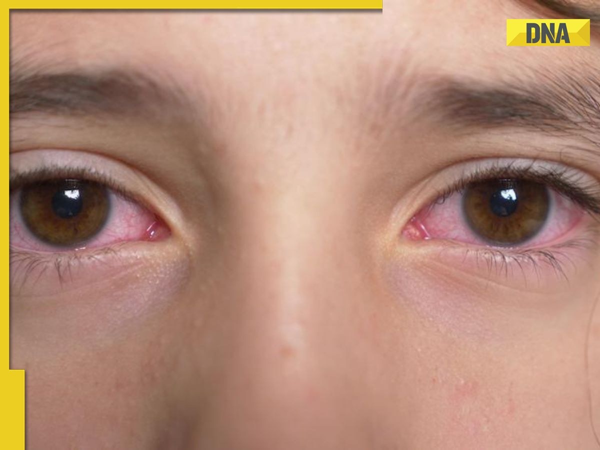 Conjunctivitis alert: How to protect your school-going child from eye infection?