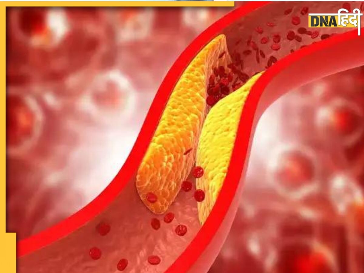 High Cholesterol Fact: इन 11 प्वांट्स में छुपा है कोलेस्ट्रॉल कम करने का तरीका, कभी नहीं आएगा हार्ट अटैक-स्ट्रोक