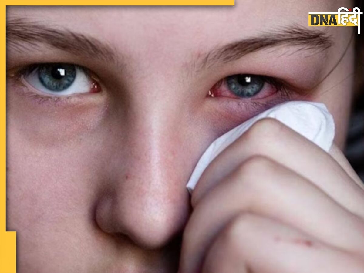 आंखों में है जलन और खुजली तो तुरंत करें ये काम, एक्सपर्ट्स ने Eye Flu के लिए बताया कारगर