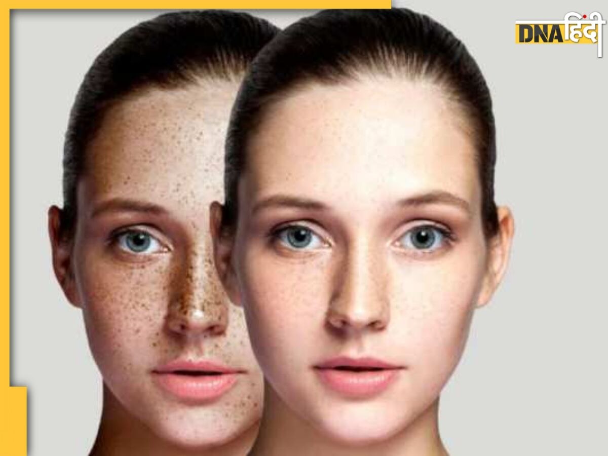 Home Remedy For Pigmentation: चेहरे पर पिगमेंटेशन से परेशान हैं? ट्राय करें ये घरेलू नुस्‍खे, हफ्तेभर में दिखेगा अंतर 