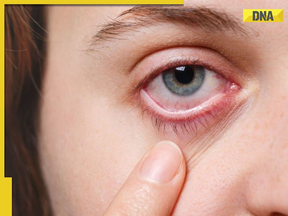 Eye Flu in India: All you need to know about these 5 types of conjunctivitis