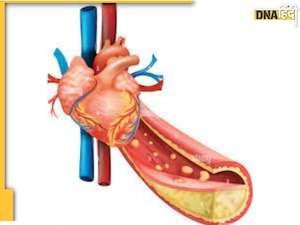 Cholesterol Treatment: ये 3 अंकुरित चीजें कोलेस्ट्रॉल में हैं रामबाण, धमनियों की वसा पिघलने से बढ़ेगा ब्लड सर्कुलेशन