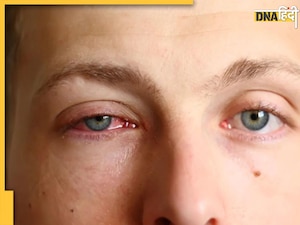 Eye Flu Diet Remedy: आई फ्लू में जरूर खाए ये 6 चीजें, जल्दी दूर होगा आंखों का इंफेक्शन