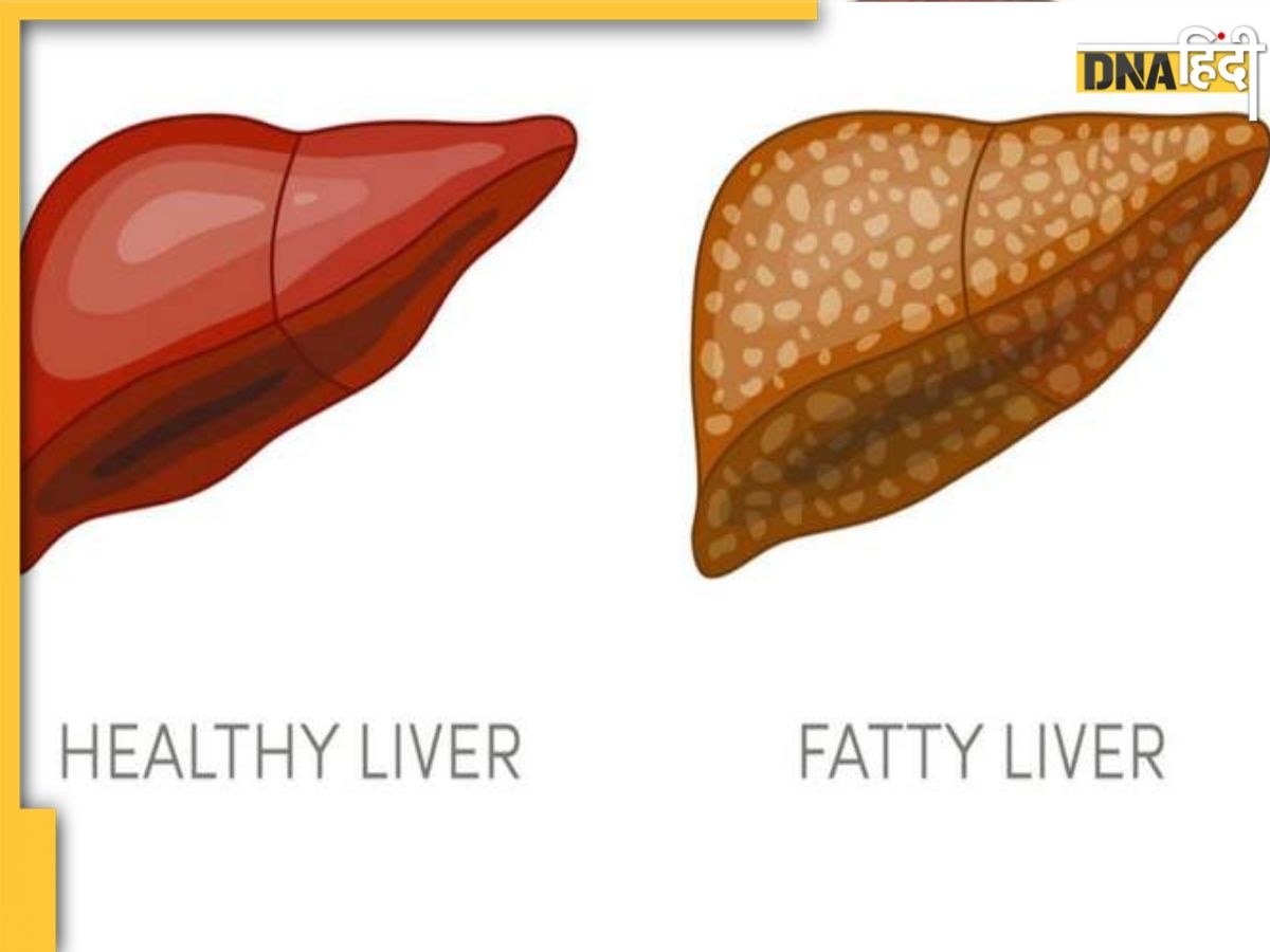 Bad Food For Liver: लिवर को सड़ा देती है ये 5 चीजें, शराब की तरह ही इस अंग पर जमाने लगती हैं चर्बी