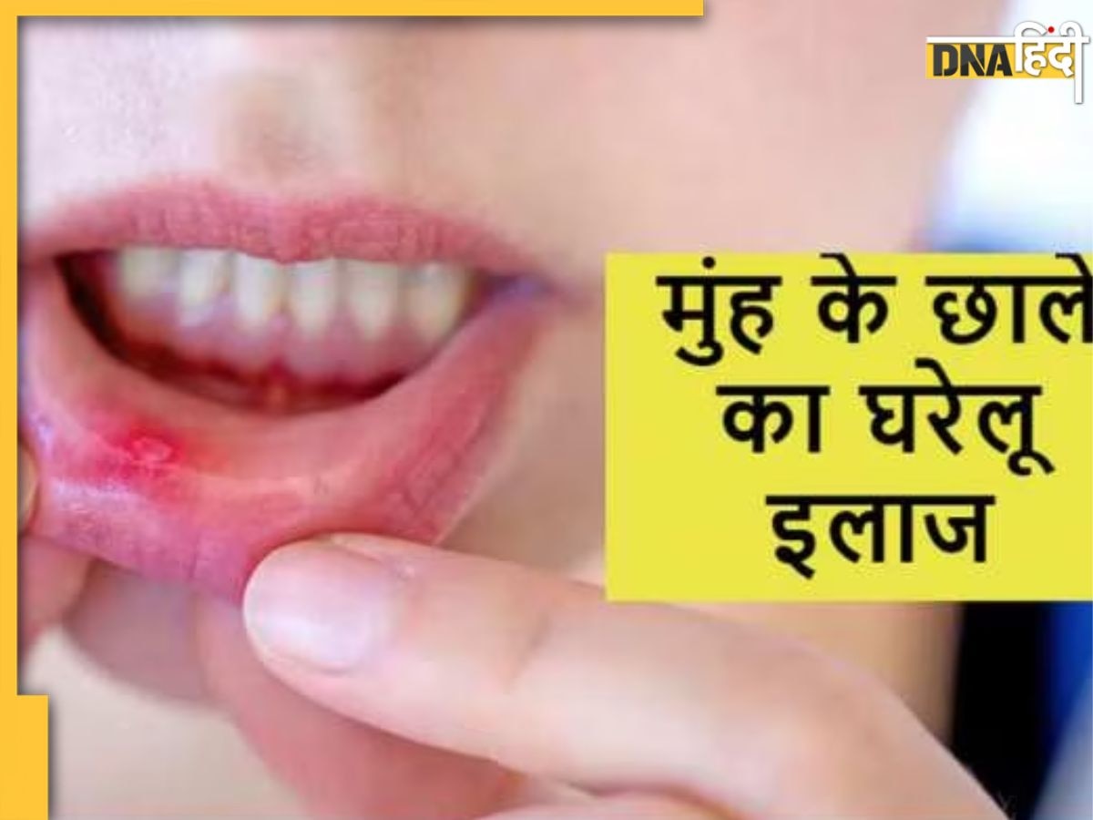 Mouth Ulcer Remedy: मुंह के छालों से मिनटों में मिलेगा आराम, आजमाकर देखें ये आसान घरेलू नुस्खा 