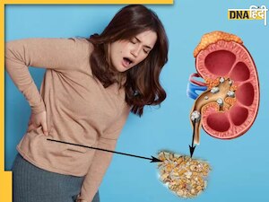 किडनी से स्टोन को बाहर कर देंगी ये 3 बेहद सस्ती चीजें, सर्जरी की भी नहीं पड़ेगी जरूरत