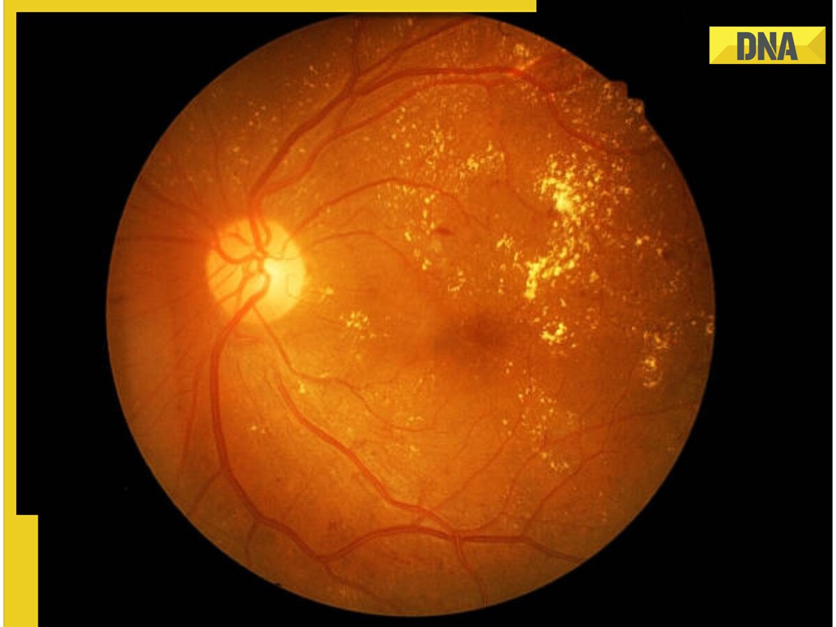 What is Diabetic retinopathy? The stealthy threat to vision and how to combat it