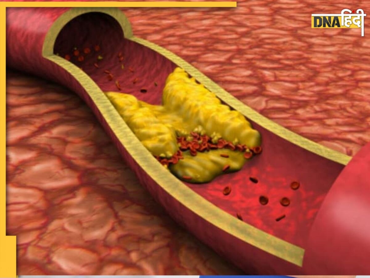 Mistakes In Cholesterol: खून में गंदा कोलेस्ट्रॉल बढ़ा सकती हैं ये 5 गलतियां, नसों में वसा की जमने लगेगी परत