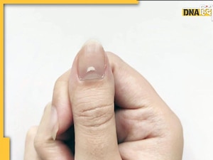 Nails colour Sign: नाखूनों का बदलता रंग बता देगा शरीर में पलने वाली बीमारी का पता 