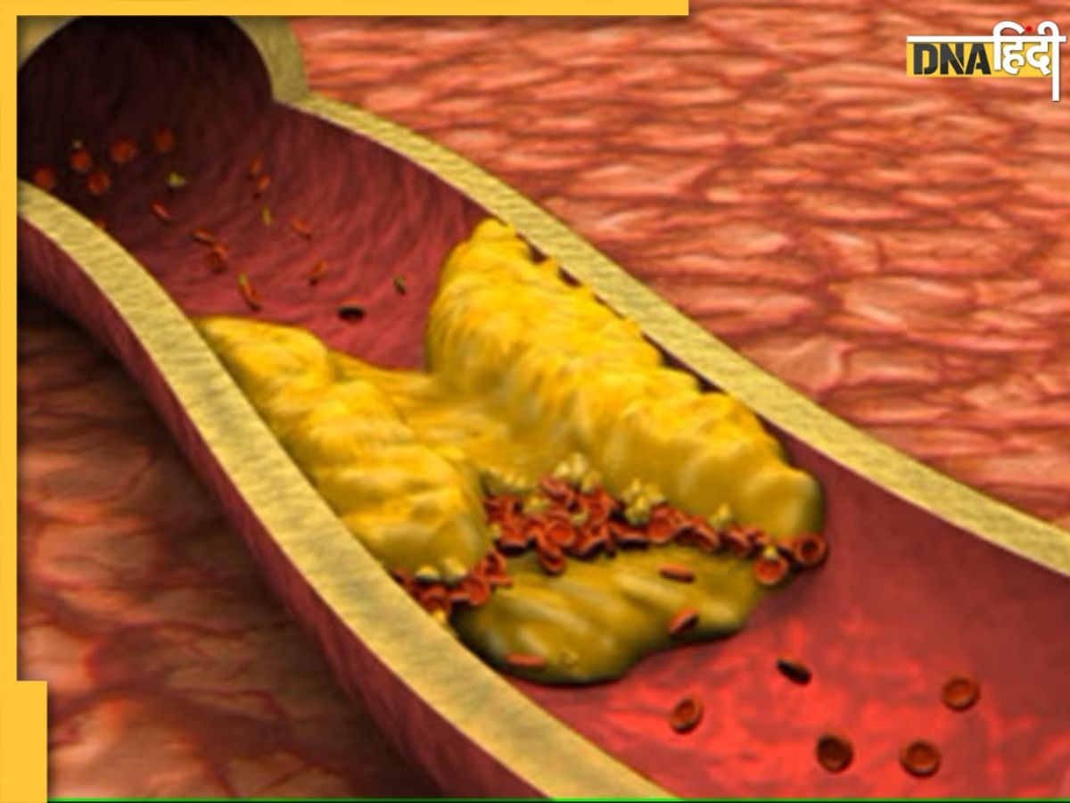 Bad Cholesterol Causes: ये 7 असामान्य चीजें नसों में भरती हैं फैट, शरीर में बढ़ता रहता है गंदा कोलेस्ट्रॉल 