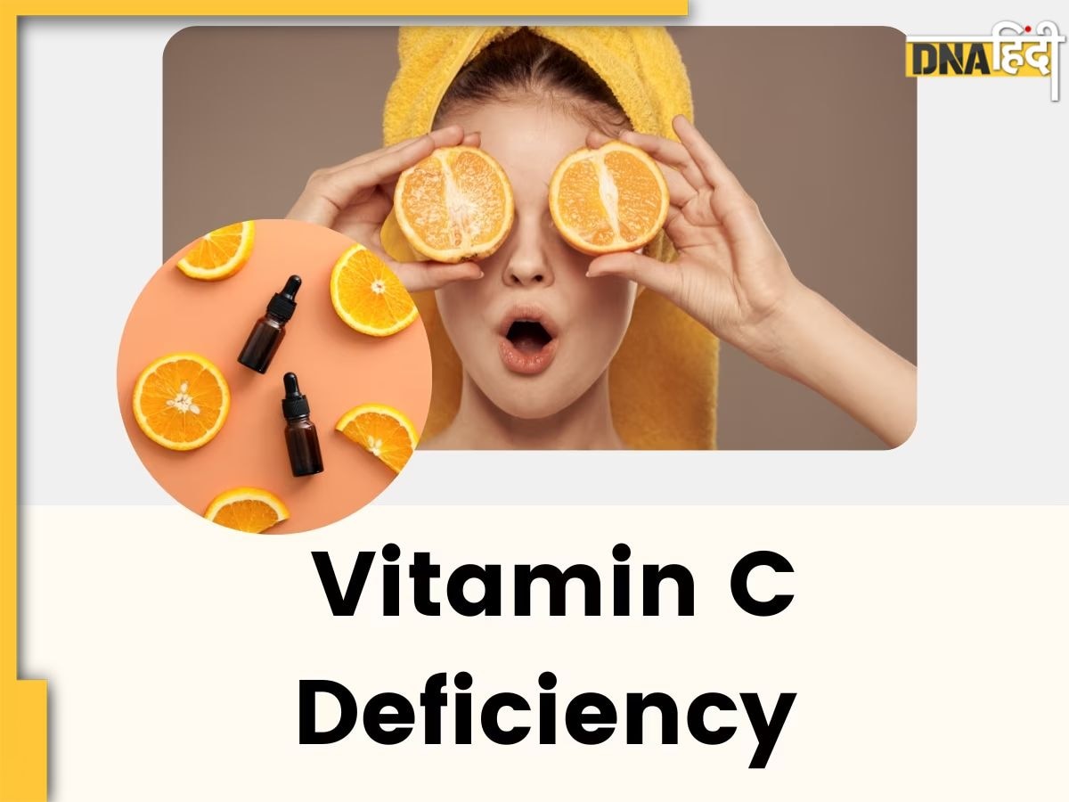 Vitamin C Deficiency ये 5 लक्षण देते हैं विटामिन सी की कमी के संकेत, न