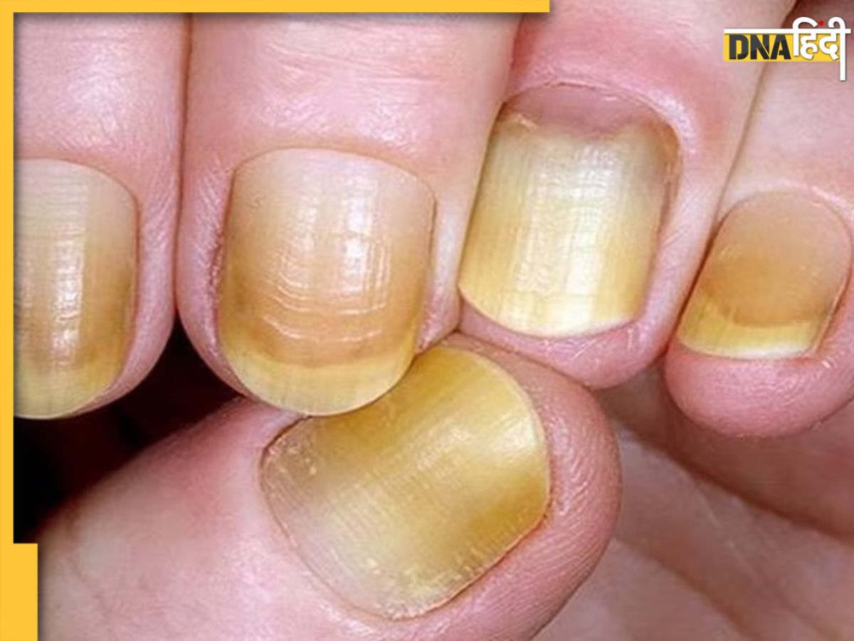 Yellow Nails: Causes, Treatment and Prevention