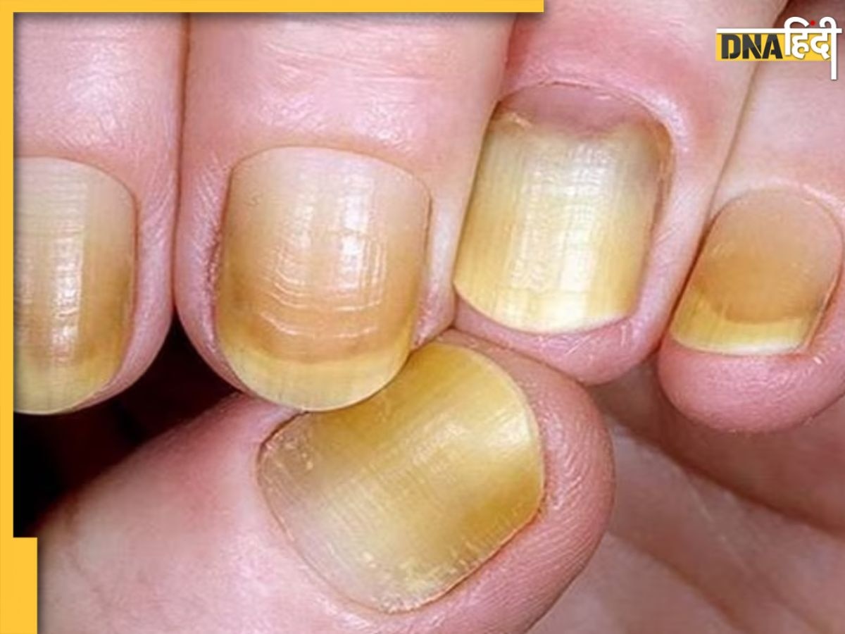 Yellow Nail Causes: पीले पड़ रहे हाथ-पैर के नाखून इन गंभीर बीमारियों के हैं संकेत, भूलकर भी न करें नजरंदाज 