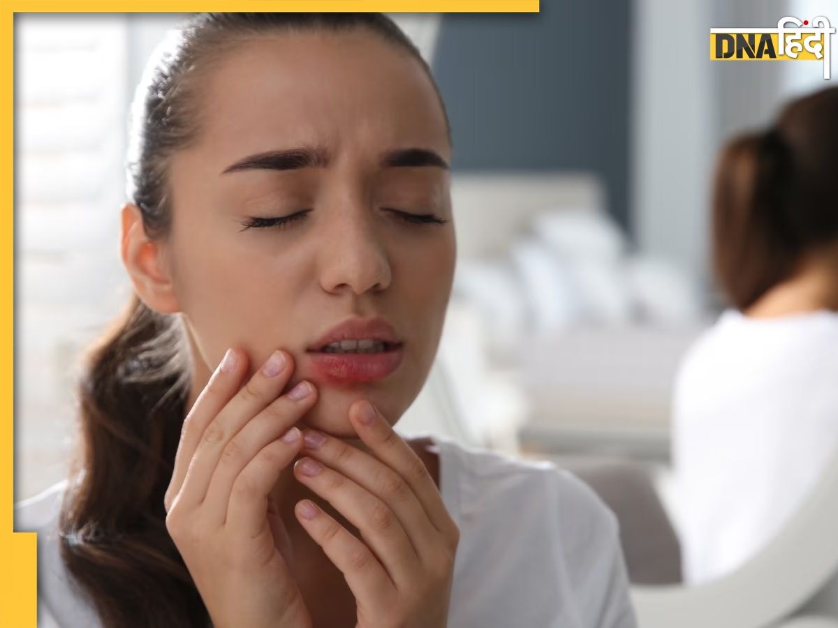 Mouth Ulcer Remedies: मुंह के छालों से हैं परेशान तो अपनाएं ये 5 घरेलू उपाय, एक ही रात में दूर हो जाएंगे छ�ाले