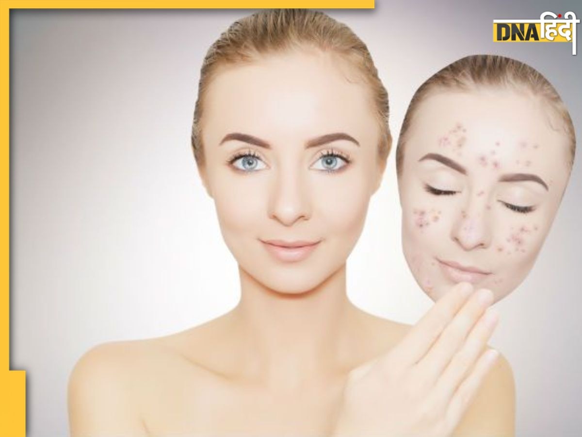 Dark Spots Removal Tips: चेहरे पर दाग-धब्बों से कम हो रही है खूबसूरती, इन आसान उपायों से दूर होगी समस्या