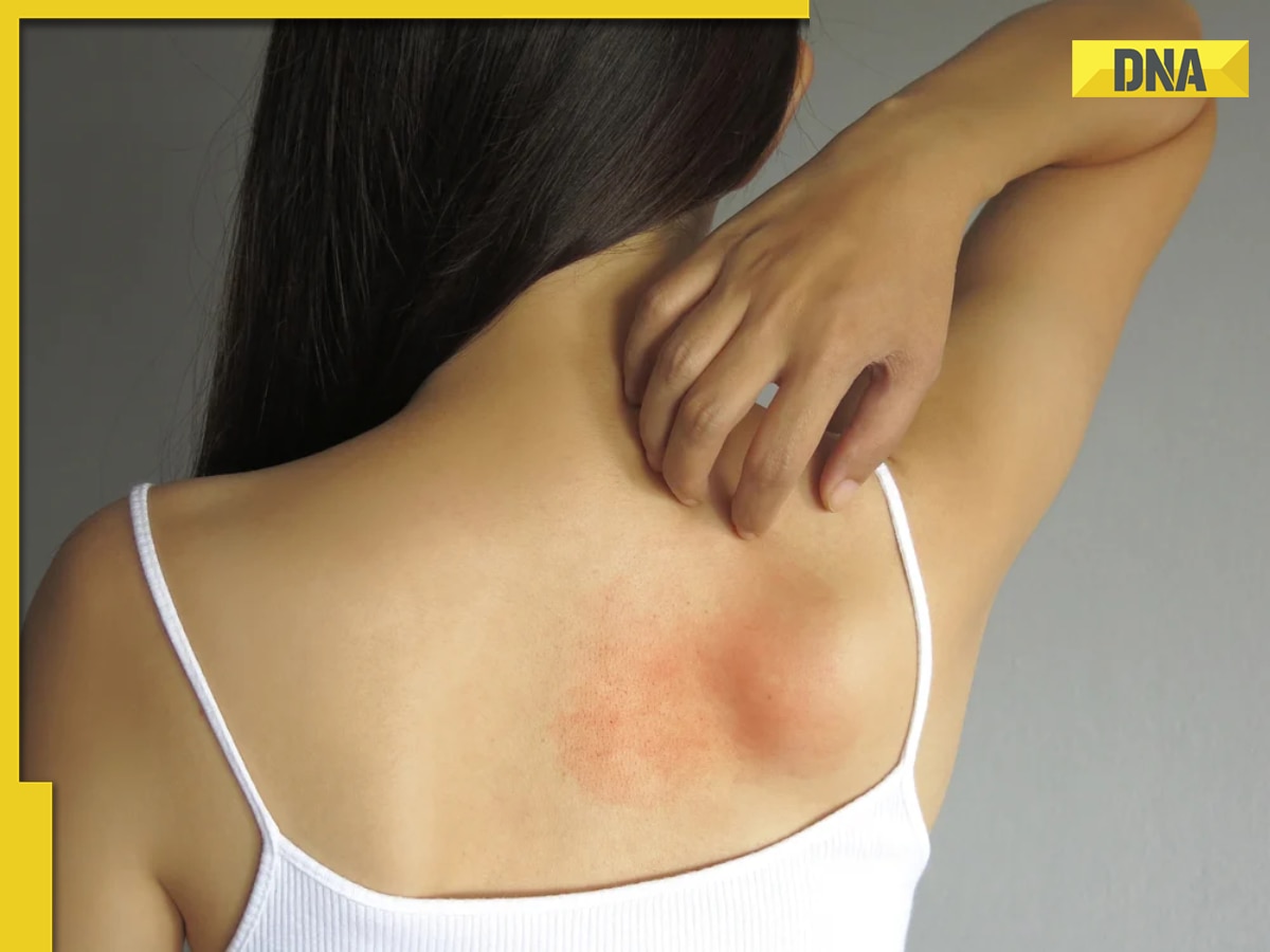 What is pityriasis rosea: All you need to know about the skin rash disease