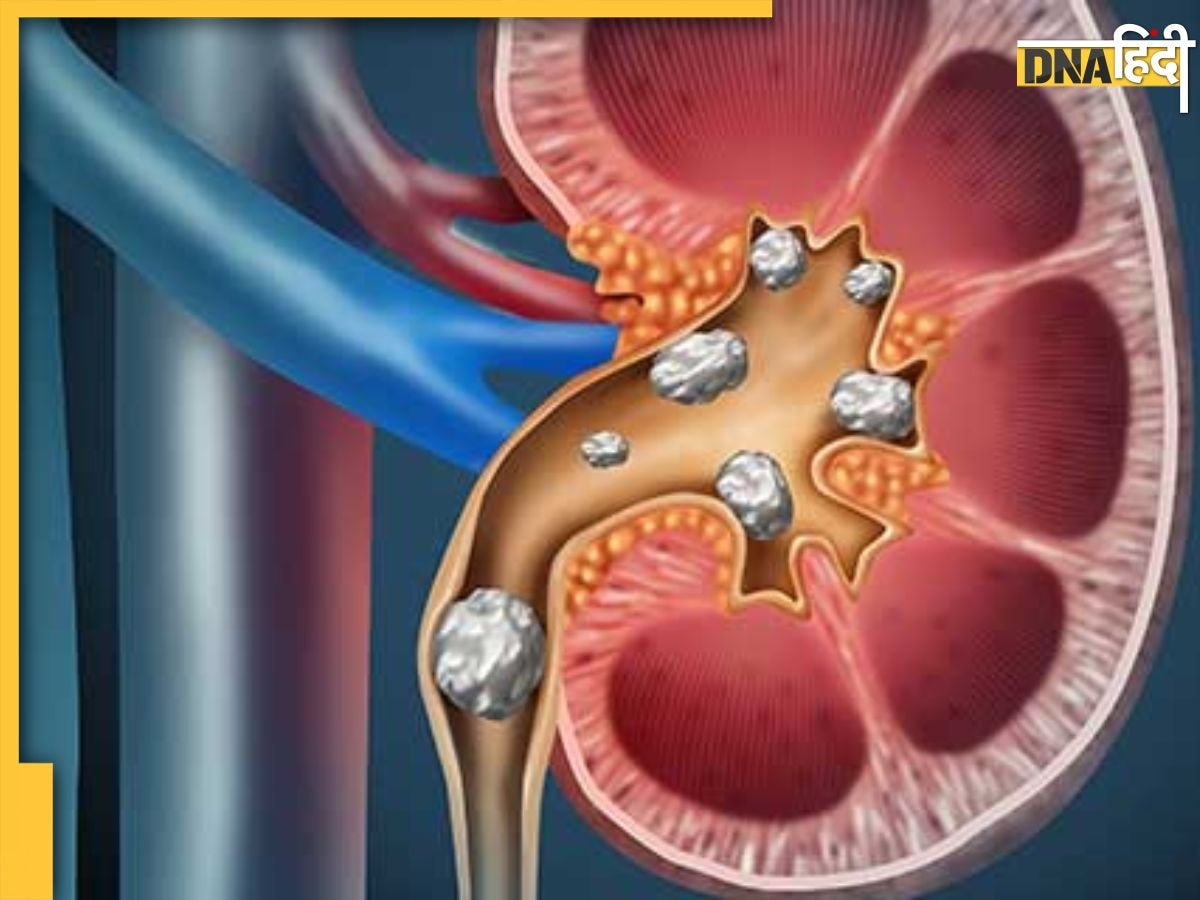 पथरी को गलाकर बाहर कर देगा इस फल का पानी, किडनी में जमा गंदगी और प्यूरीन को करता है फ्लशआउट