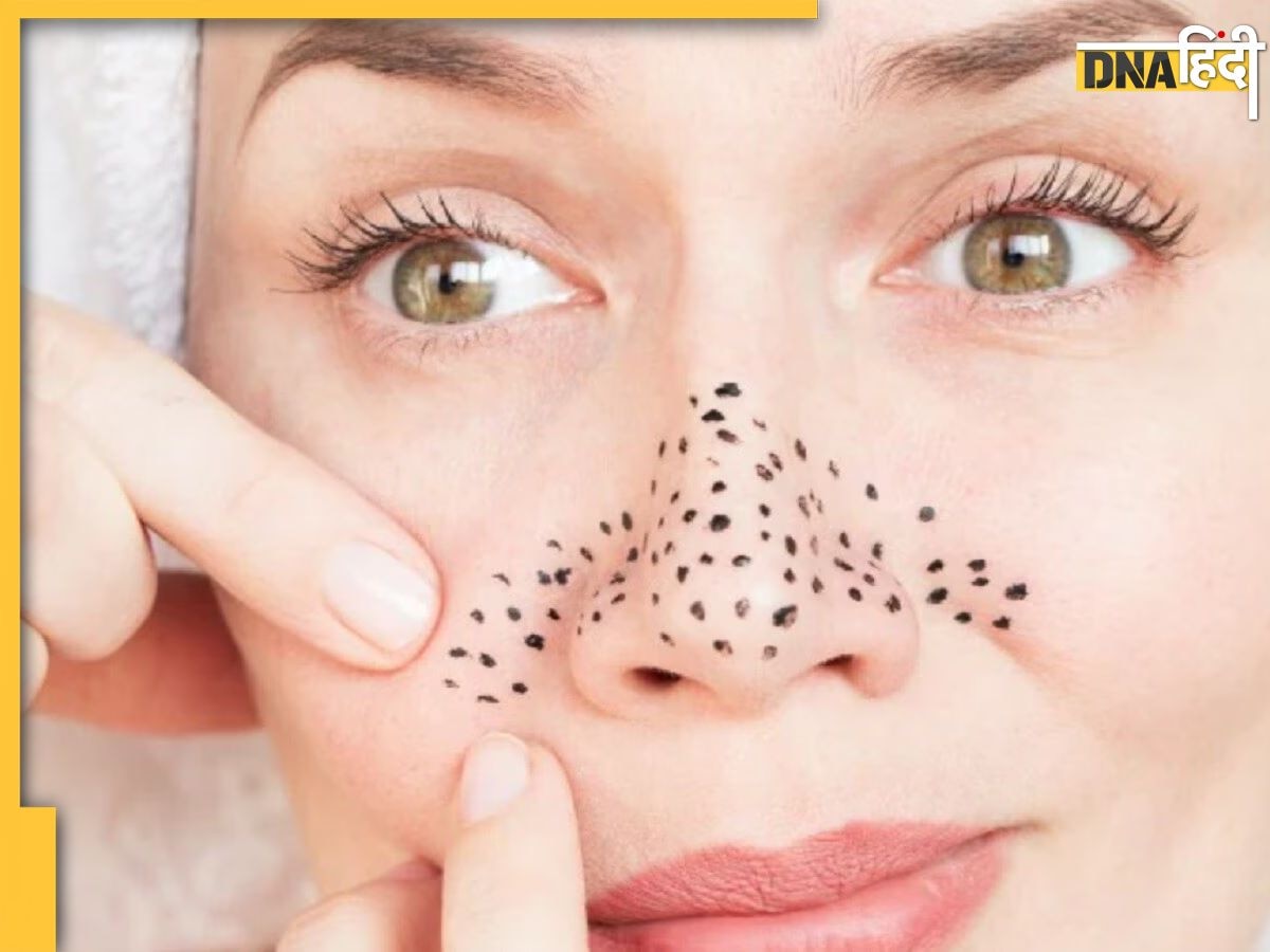 Blackheads Remove Tips: नाक पर जमा हो गए हैं ब्लैकहेड्स तो न हो परेशान, इन देसी ट्रिक से मिल जाएगा छुटकारा