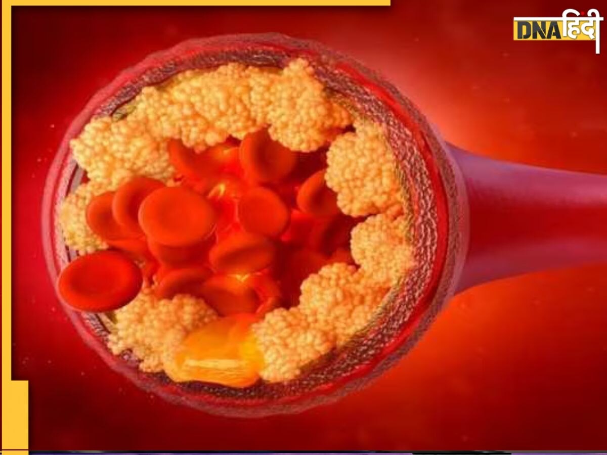 Cholesterol Control: कोलेस्ट्रॉल कम करने के लिए कभी ज्यादा न लें ये एक चीज, किडनी खराब होने का बढ़ेगा खतरा