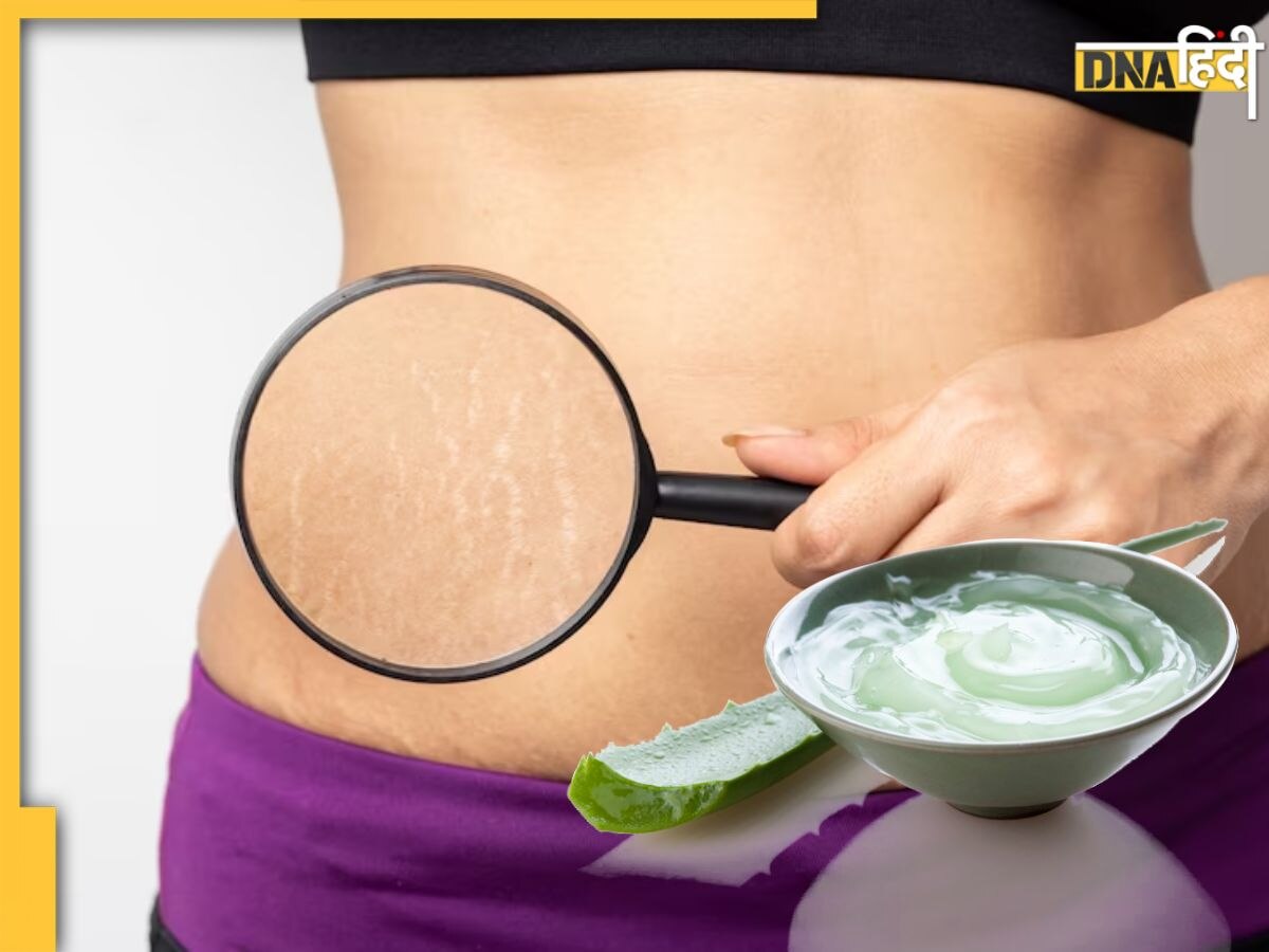 Stretch Marks Removal Remedy: शरीर पर भद्दे दिखने वाले स्ट्रेच मार्क्स को दूर करेगा एलोवेरा जेल, ऐसे करें इस्तेमाल