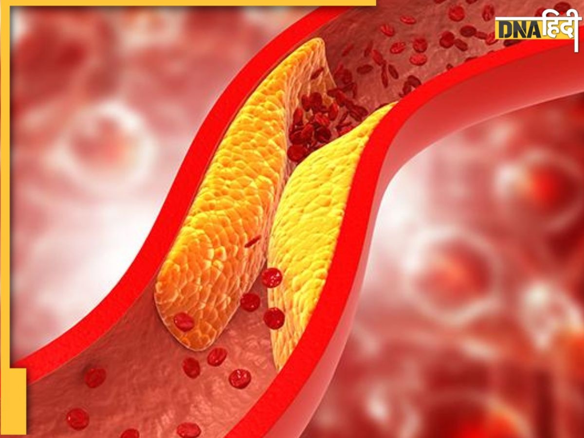 Cholesterol Remedy: नसों में जमा गंदा कोलेस्ट्रॉल पानी बना देंगे ये 6 फूड, बिना दवा ही कम होने लगेगी ब्लड में जमी वसा