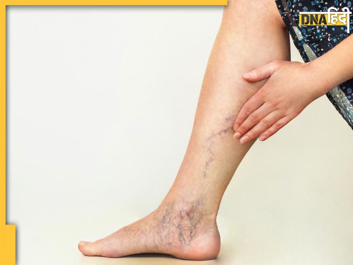 Varicose Veins: क्या है वैरिकोज वेन्स? जिससे फूलने लगती हैं हाथ-पैर की नसें, जानें लक्षण