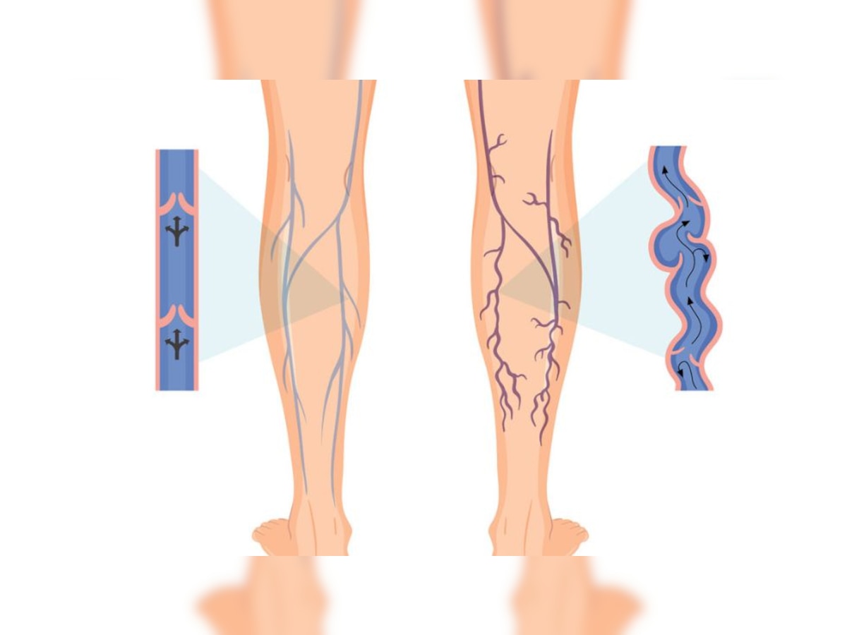 When to See a Doctor For Varicose Veins: Warning Signs and Diagnosis
