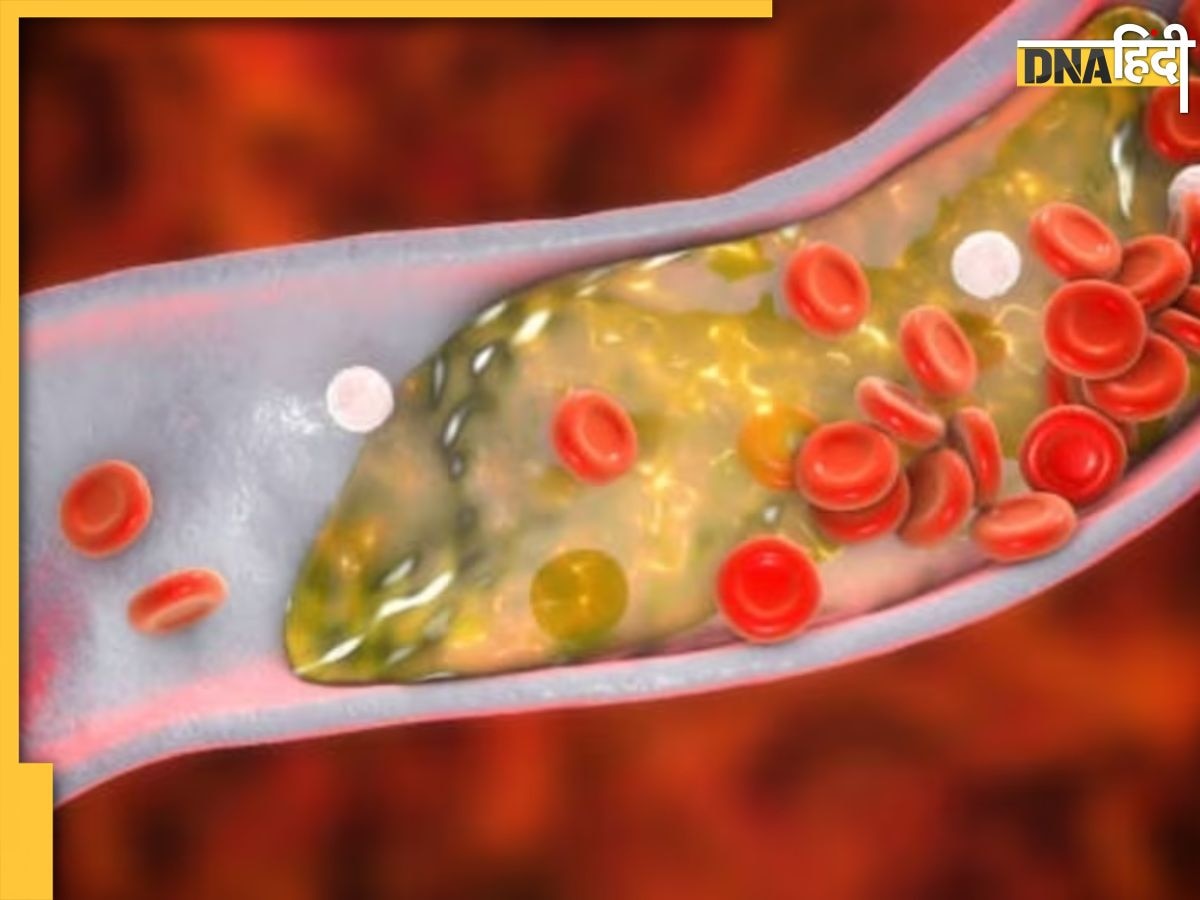 Bad Cholesterol Effects: दिल के लिए घातक होता है बैड कोलेस्ट्रॉल, साइलेंट तरीके से जान ले लेती है यह बीमारी, ऐसे करें  बचाव