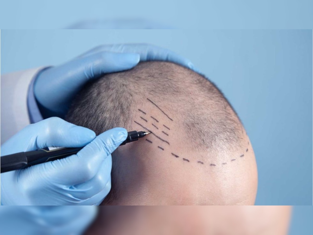 Best Hair Transplants and Hair Transplant Cost in Turkey