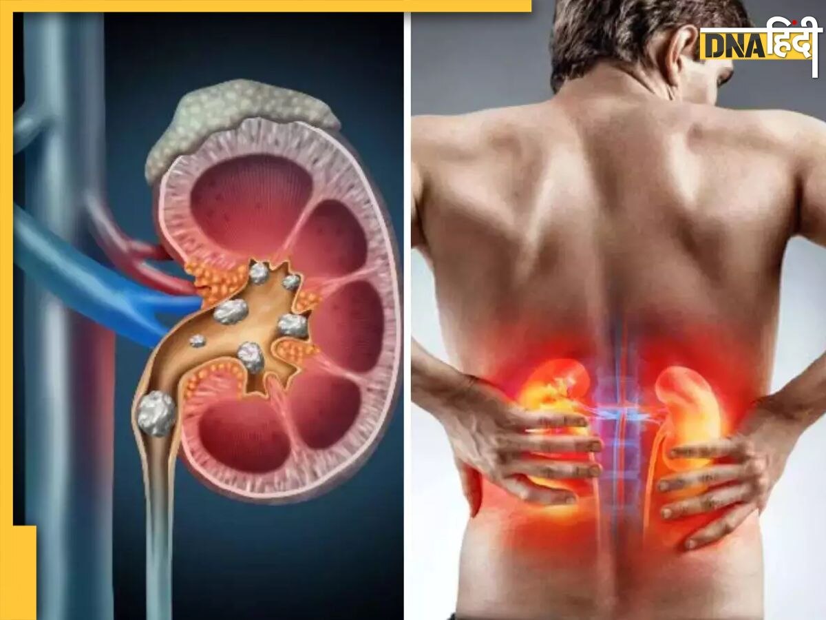 Kidney Stones: किडनी में पथरी से हैं परेशान तो डाइट में शामिल कर लें ये फल, बिना ऑपरेशन बाहर हो जाएगा स्टोन