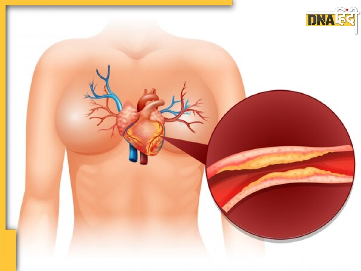 High Cholesterol Symptoms: ये लक्षण बताते हैं शरीर में बढ़ रहा गंदा कोलेस्ट्रॉल, कभी भी पड़ सकता है दिल का दौरा