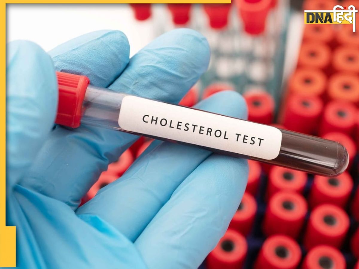 Cholesterol Test कोलेस्ट्रॉल के लिए ब्लड टेस्ट कराने से पहले इन 5