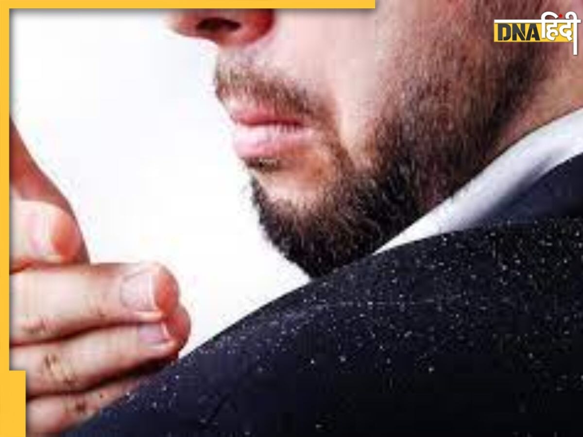 Dandruff Kaise Hataye: सर्दियों में बालों का डैंड्रफ कर रहा है परेशान, इन घरेलू उपायों से दूर होगी रूसी