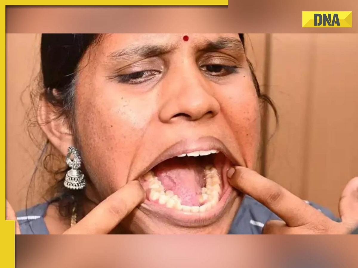 Indian Woman Sets Guinness World Record For Having 38 Teeth In Her Mouth 4588