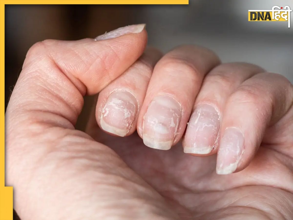 Nails Signs Of Health: नाखूनों पर पीले और सफेद धब्बे बयां करते हैं सेहत का हाल, इन बीमारियों का देते हैं संक��ेत