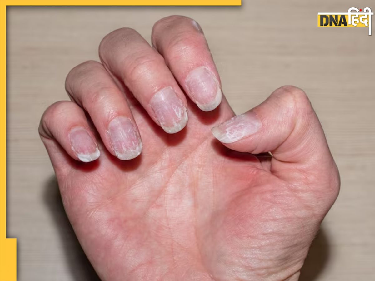 Zinc deficiency and nails: Relationship, signs, treatment, and more