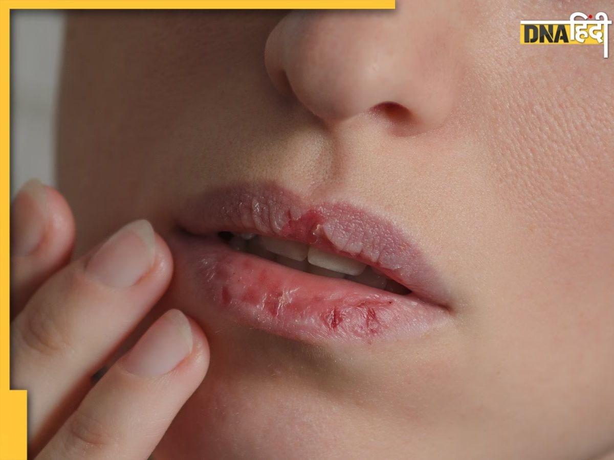 Dry Lips Care: सर्दियों में फट रहे हैं होंठ तो लिप केयर के लिए फॉलो करें ये 6 टिप्स, मुलायम और खूबसूरत रहेंगे होंठ