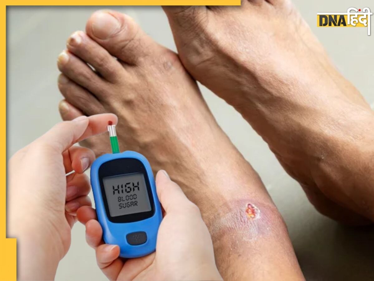 Diabetic Foot Ulcer: डायबिटीज मरीज पैरों के घाव और छालों को न करें नजरअंदाज, हो सकता है गंभीर संक्रमण