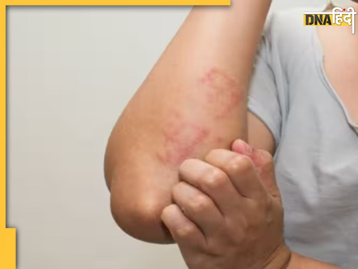 Dermatitis Symptoms: त्वचा पर फफोले-खुजली समेत ये लक्षण हैं डर्मेटाइटिस के संकेत, तुरंत कराएं इलाज