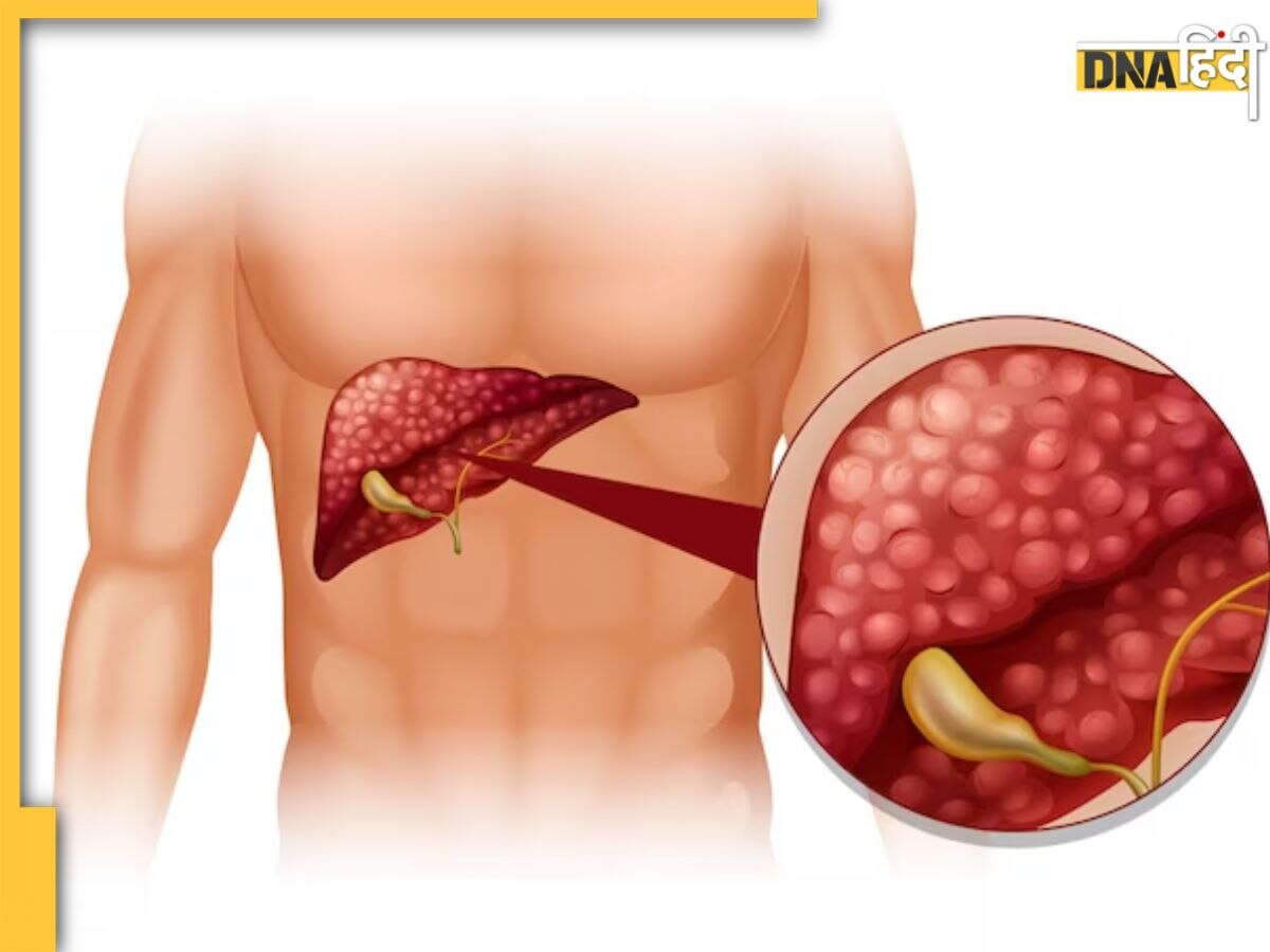 Liver Cirrhosis And Diabetes: शुगर हाई रहने से अंदर ही अंदर सड़ने लगता है लिवर, ये लक्षण दिखें तो तुरंत कराएं जांच