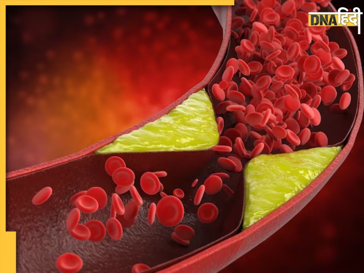 High Cholesterol Foods: नसों में गंदा कोलेस्ट्राॅल भर देती हैं ये 5 चीजें, हार्ट मरीज तुरंत बना लें दूरी