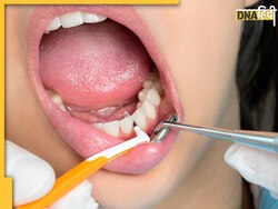 Cavity Pain Remedies: दांतों की कैविटी और मसूड़ों की सूजन के लिए दांत पर रगड़ें ये एक चीज, तुरंत मिलेगा आराम