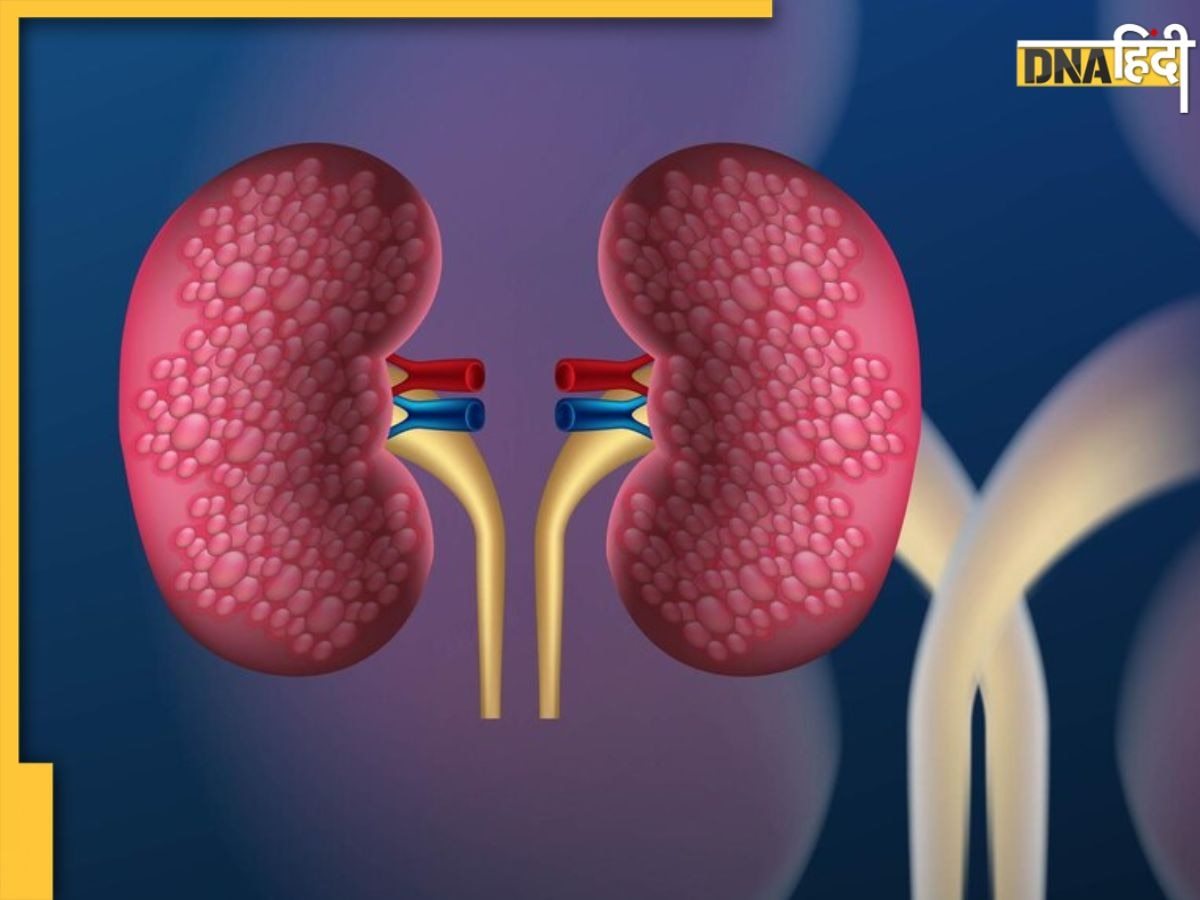 Polycystic Kidney Disease: क्या है पॉलीसिस्टिक डिजीज, जिससे किडनी में बन जाता है अल्सर, जानें लक्षण और बचाव के उपाय