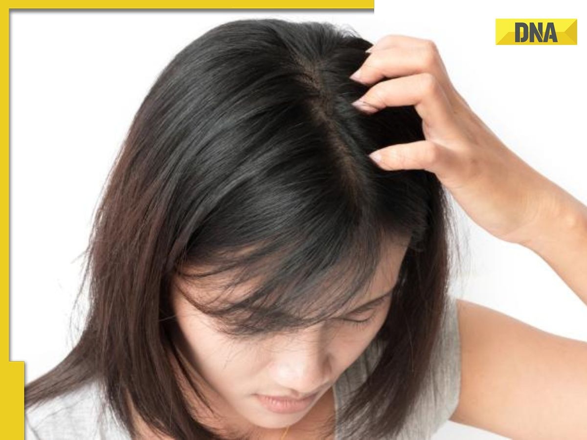 Dandruff in winter: 5 Ayurveda remedies to treat dry and flaky scalp naturally 