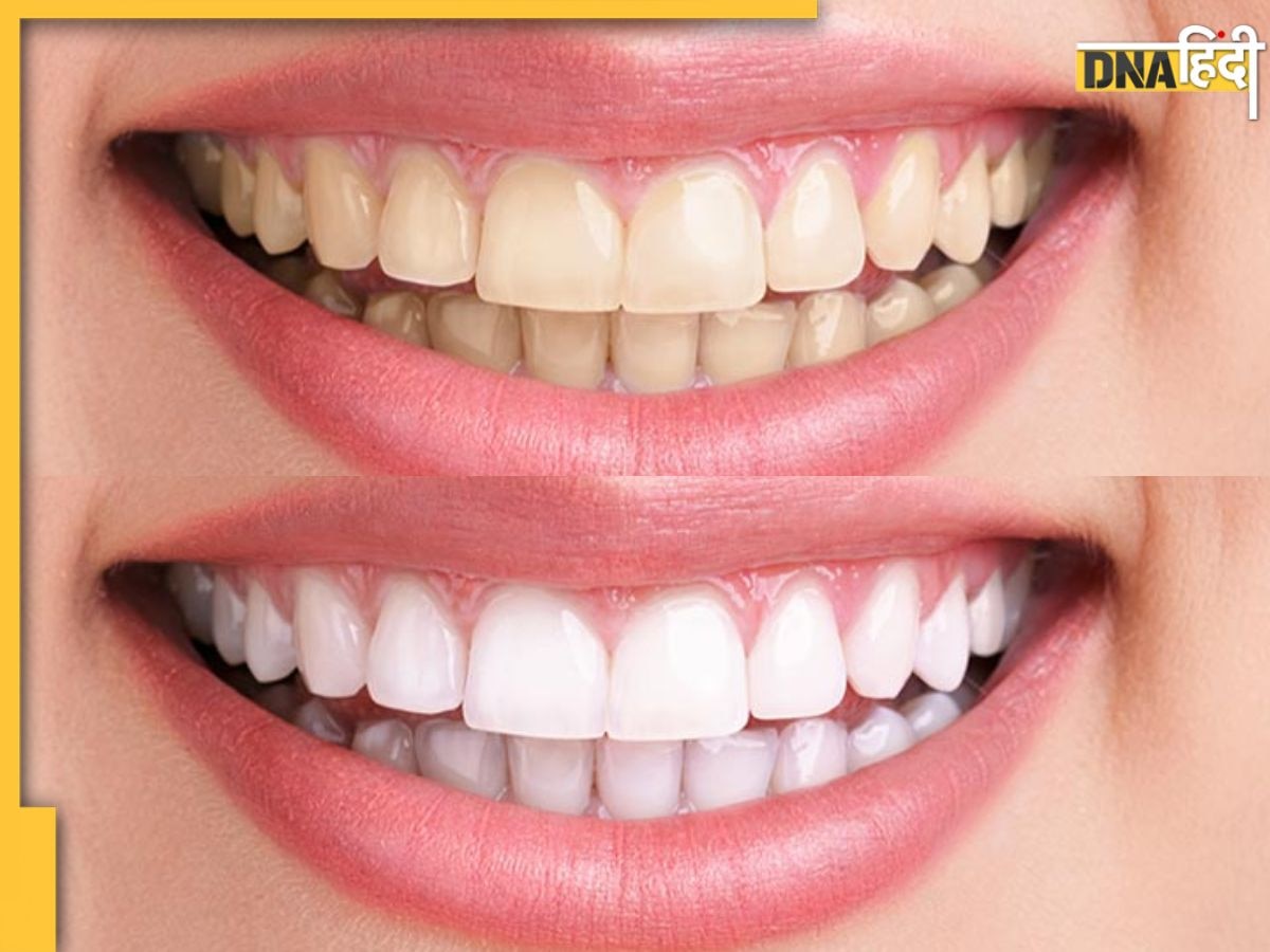 Teeth Whitening Remedies: रोज ब्रश करने के बाद भी नहीं हटता दांतों पर जमा जिद्दी पीलापन, इन उपायों से चमकेगी बत्तीसी