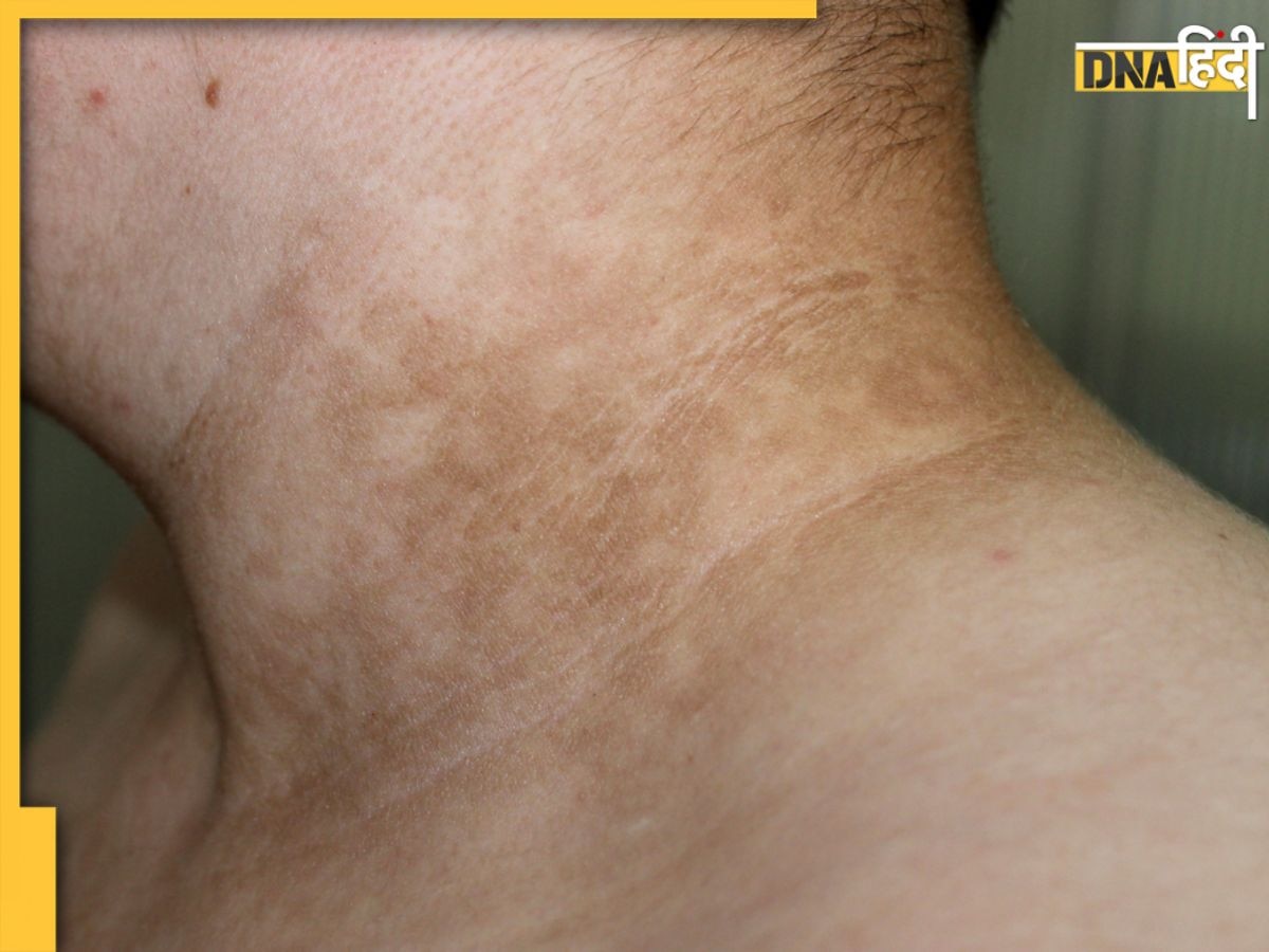 Neck Darkness Causes: मैल की परत नहीं, इस गंभीर बीमारी के कारण गर्दन पड़ जाते हैं काले, न करें अनदेखा