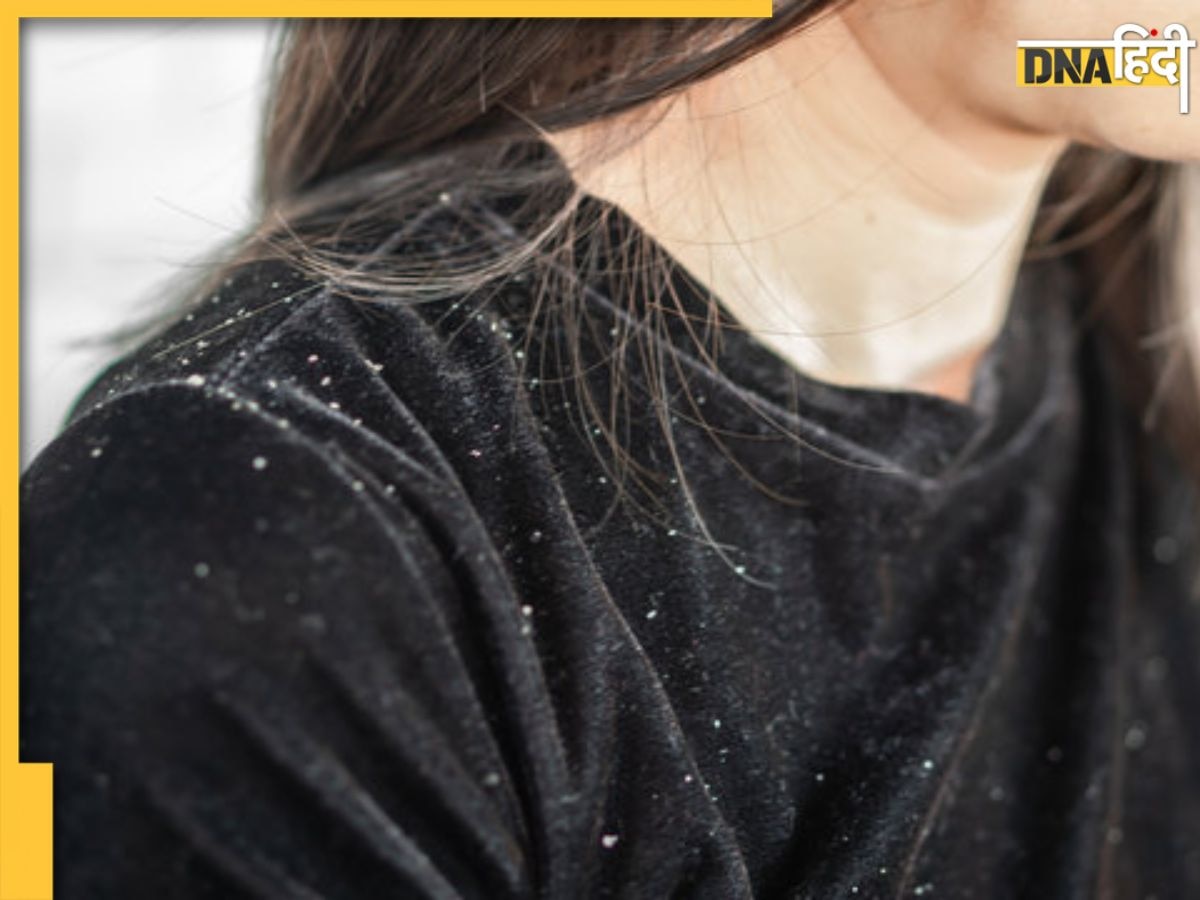 Dandruff Remedies: स्नोफॉल की तरह झड़ रहा है डैंड्रफ, सिर में लगाएं इनमें से कोई एक चीज और देखें असर