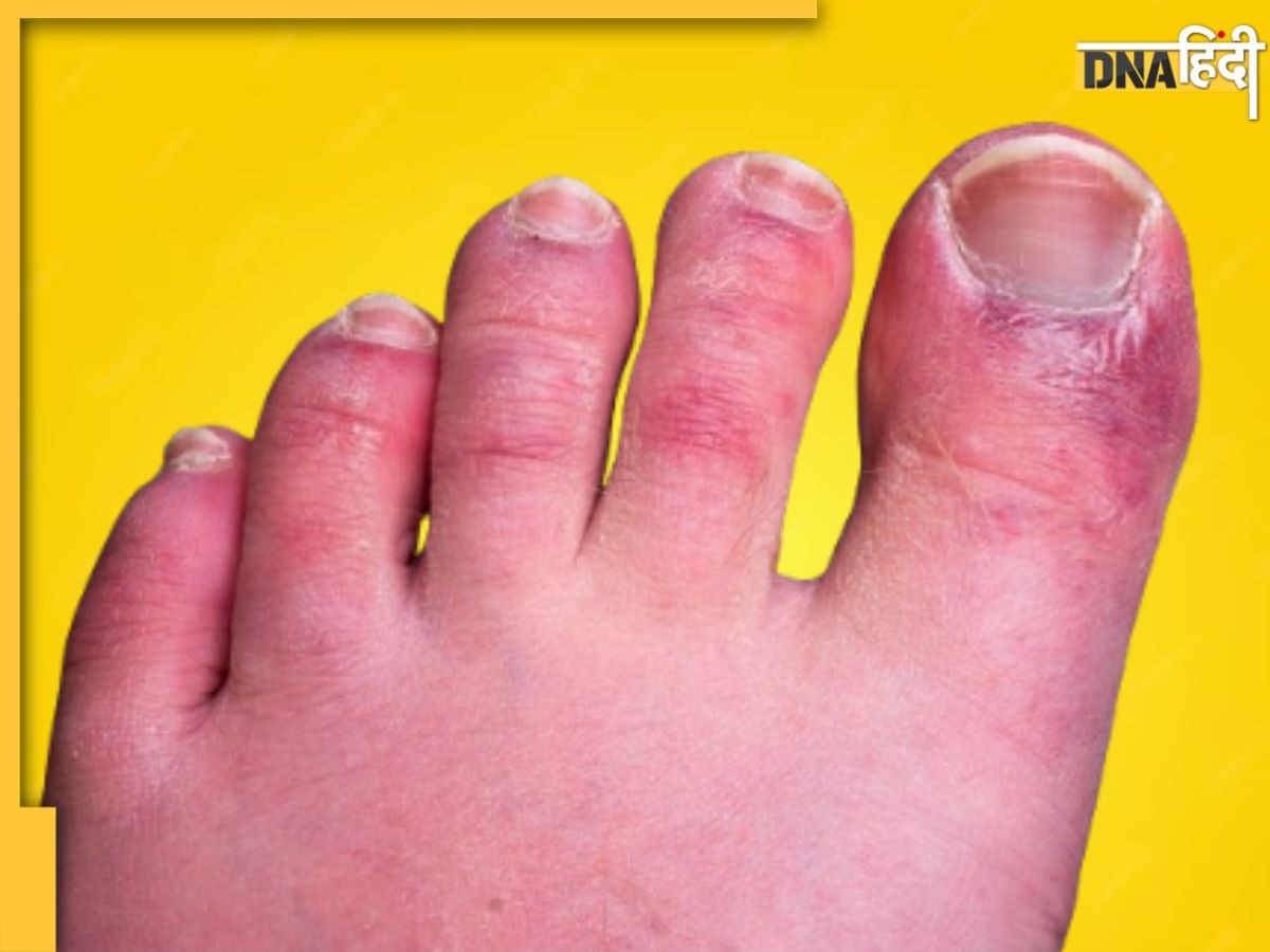 Blisters Itchiness Causes: ठंड में हाथ-पैर में खुजली और जलन इस गंभीर बीमारी की ओर करता है इशारा, न करें अनदेखा