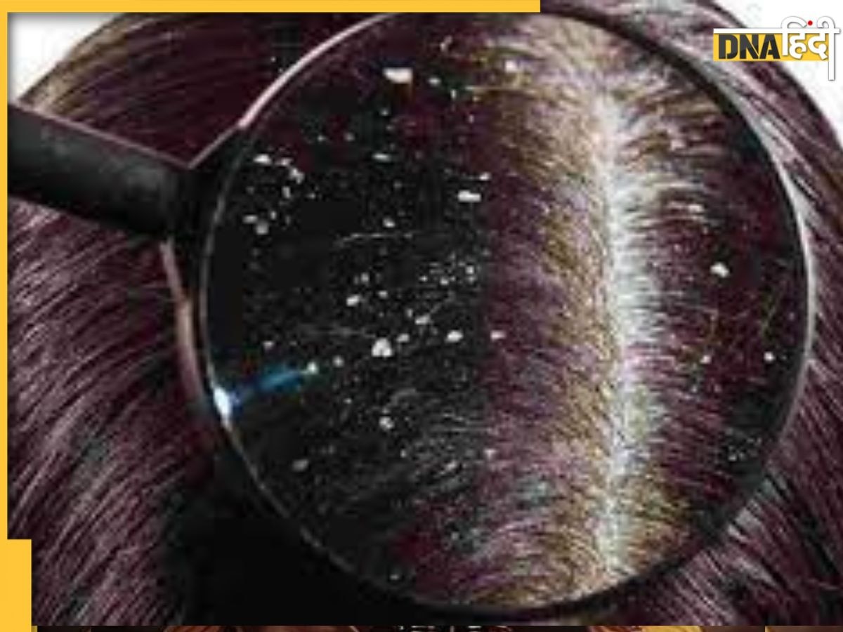 Dandruff Removal Remedy: इन 2 विटामिन और मिनरल की कमी से रूसी और बालों का झड़ना होगा और खतरनाक, नहीं दिया ध्यान तो होंगे टकले