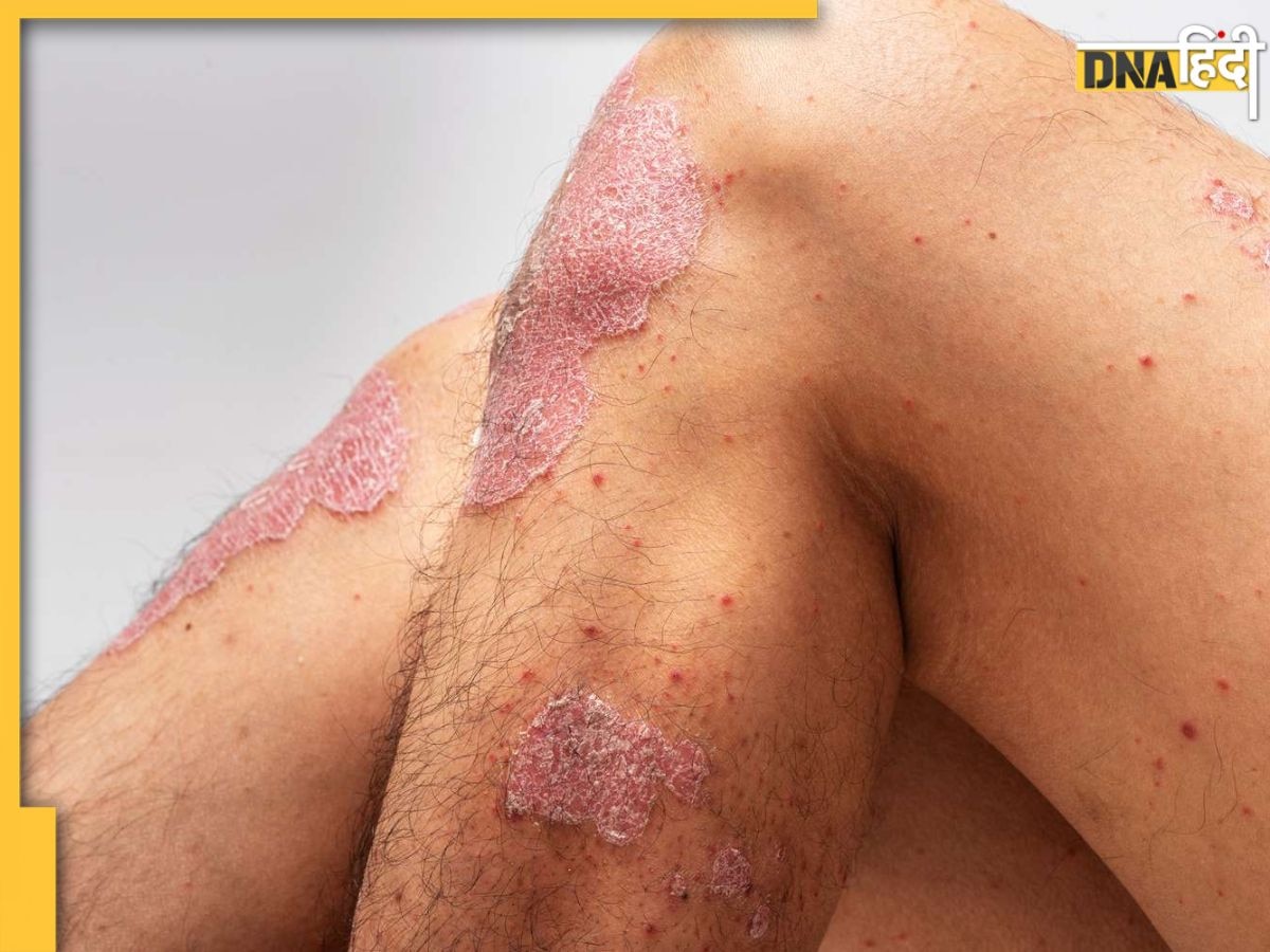 Red Patches On Skin: शरीर के इन हिस्सों में लाल पैच इस गंभीर बीमारी के हो सकते हैं संकेत, लक्षण दिखते ही कराएं जांच